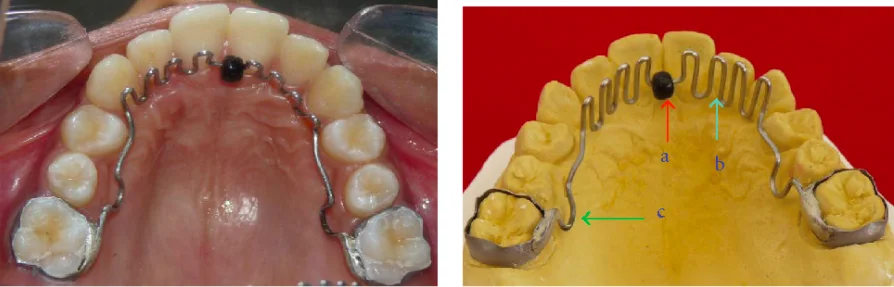 Benefits of Oral Habit-Breaking Appliances