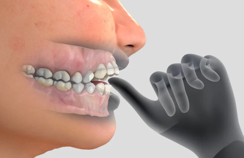 Thumb or finger sucking