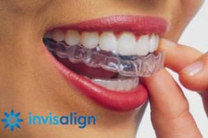 Invisalign-certified-Orthodontists-at-Growing-Smiles-Bangalore-Whitefield
