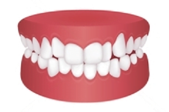 Invisalign for crowded teeth at Little Pearls Orthodontics