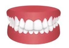 Overbite animation Invisalign at Little Pearls Orthodontics