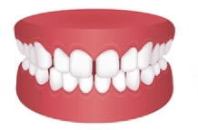 What Invisalign Can Correct - Gap Teeth
